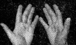 Лікуємо синдром клацаючого пальця в домашніх умовах